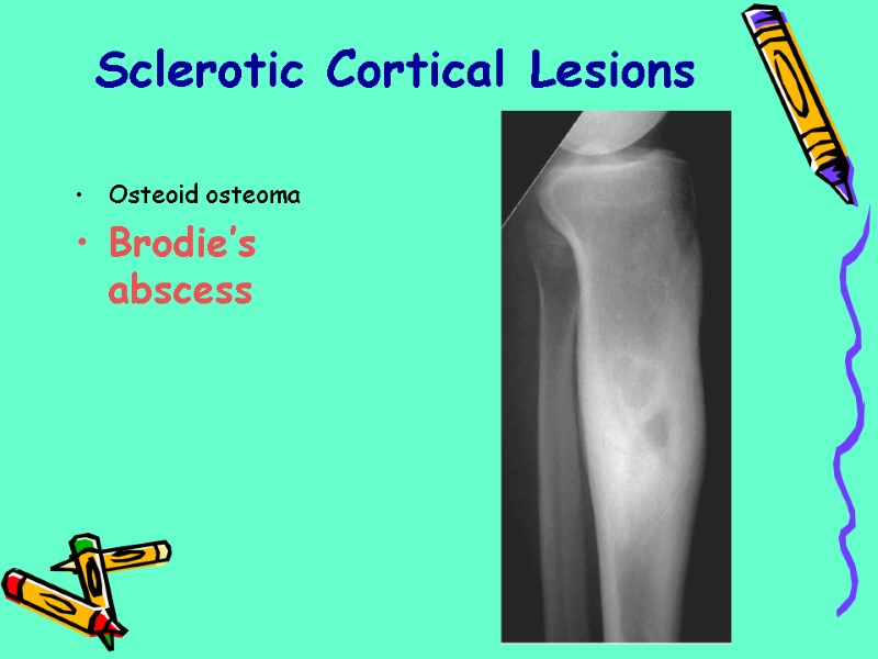 Osteoid osteoma Brodie’s abscess Sclerotic Cortical Lesions